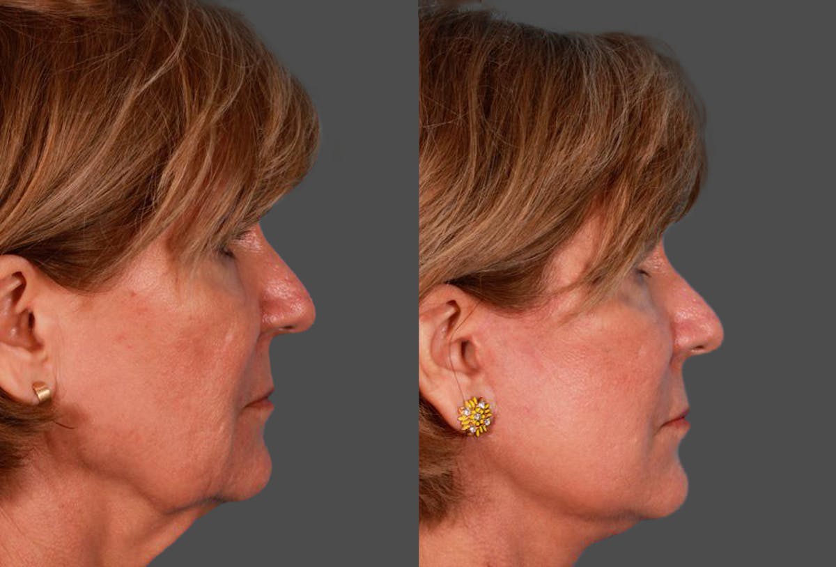 Facelift Before & After Gallery - Patient 504011 - Image 3