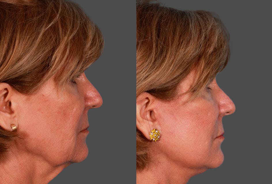 Facelift Before & After Gallery - Patient 504011 - Image 3