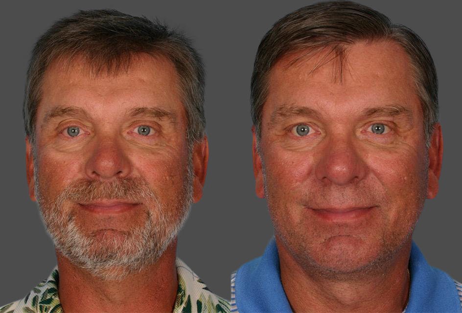 Facelift Before & After Gallery - Patient 559524 - Image 1