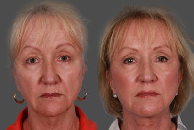 Facelift Before & After Gallery - Patient 415125 - Image 1