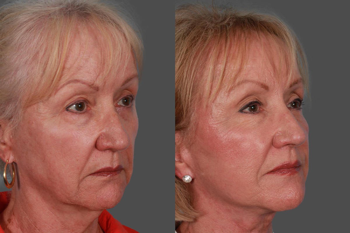 Facelift Before & After Gallery - Patient 415125 - Image 2
