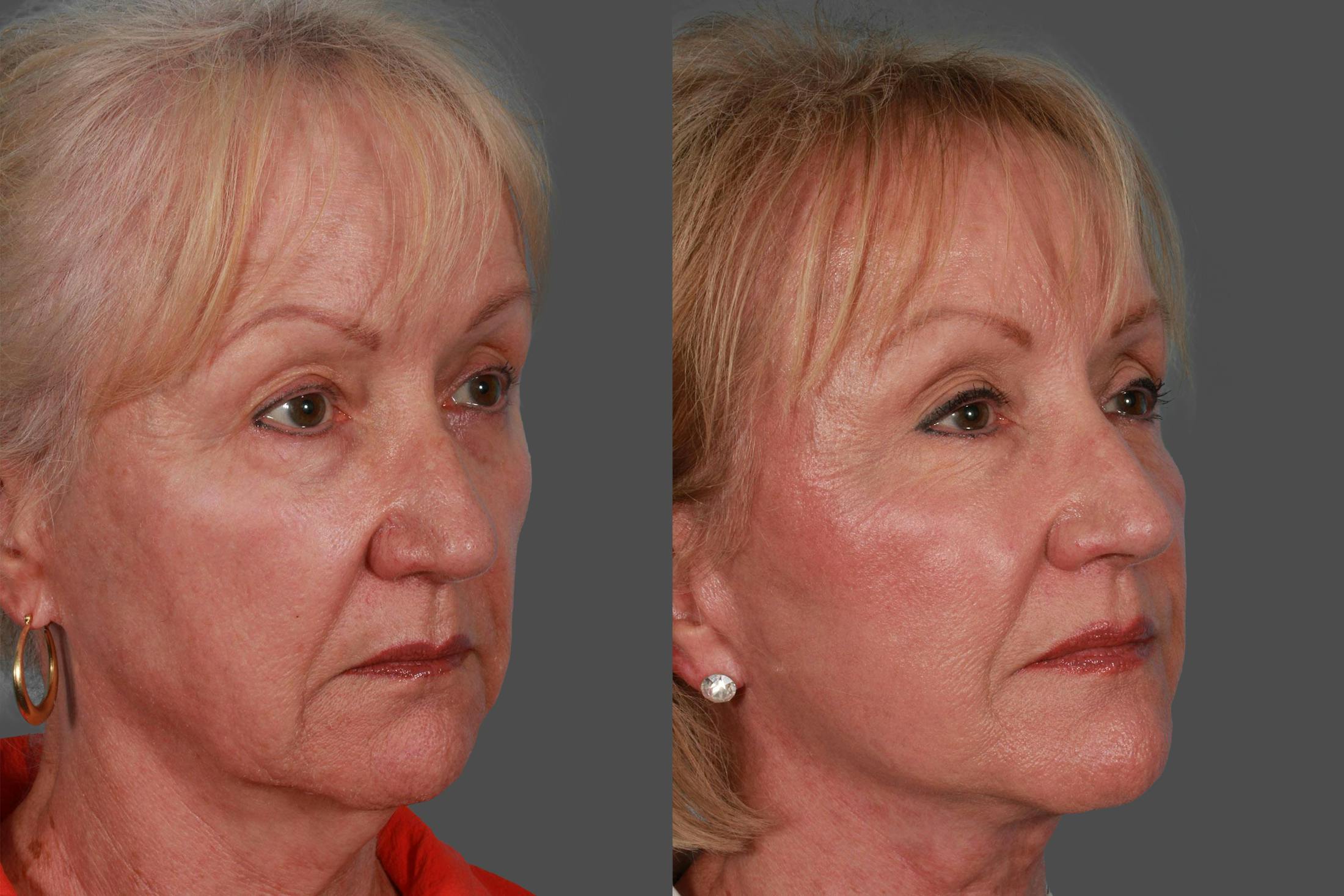 Facelift Before & After Gallery - Patient 415125 - Image 2