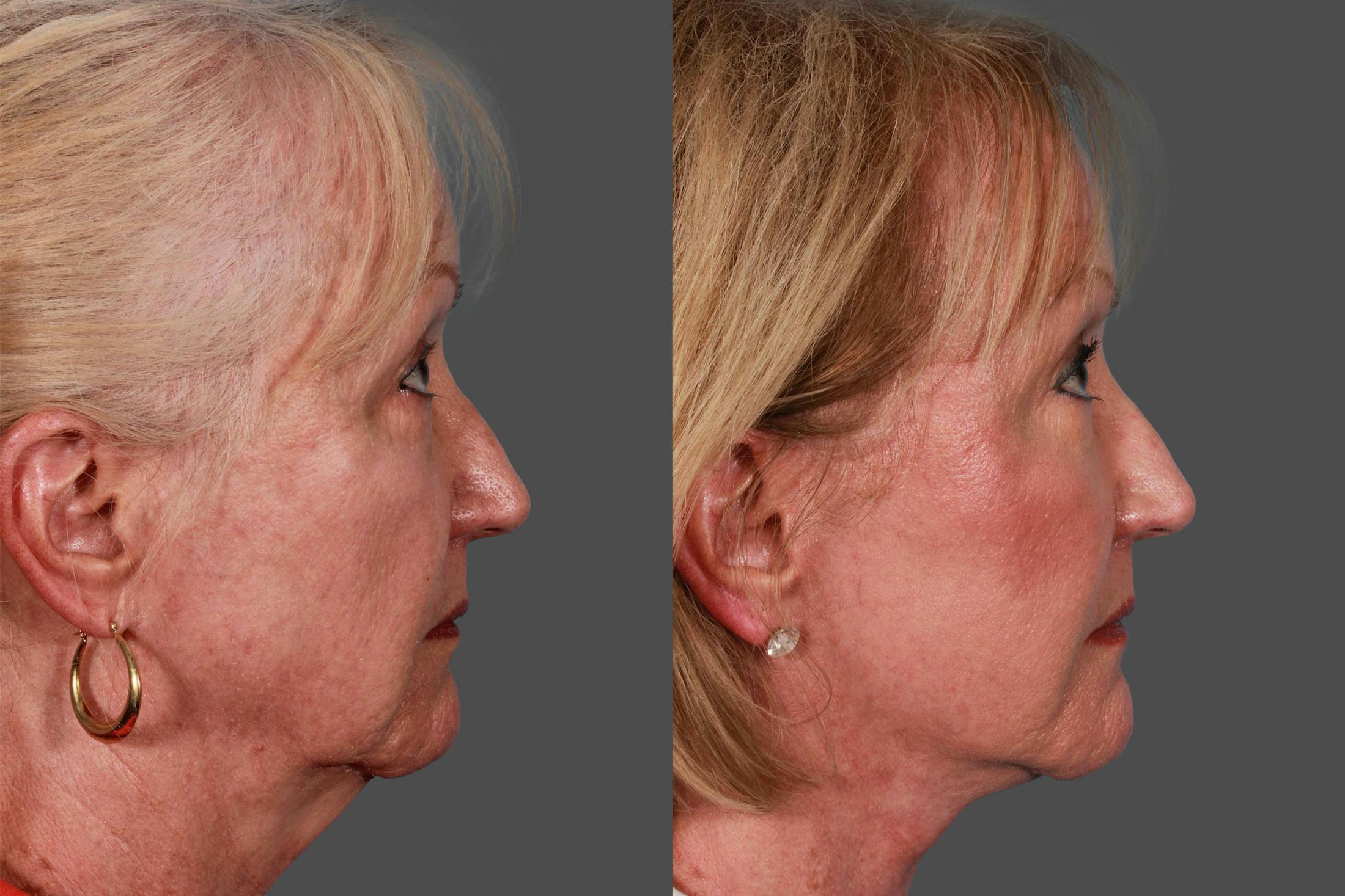 Facelift Before & After Gallery - Patient 415125 - Image 3