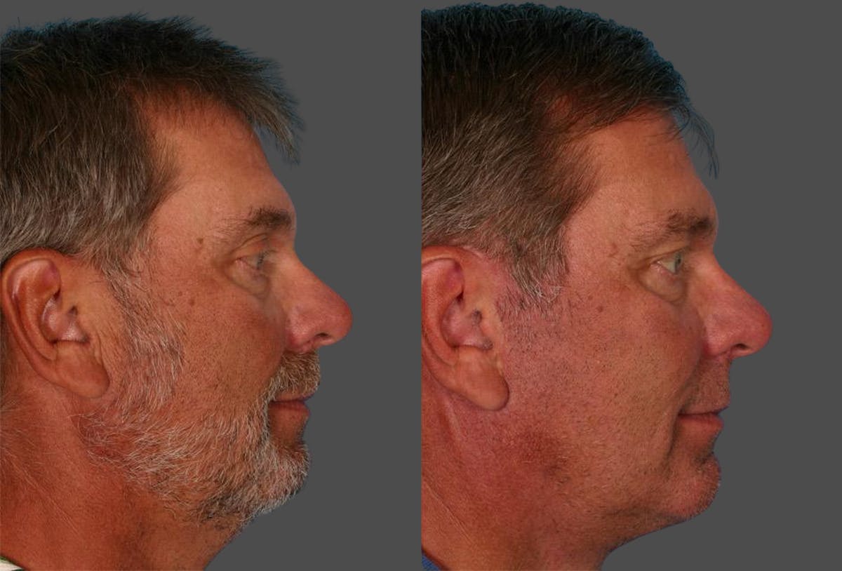 Facelift Before & After Gallery - Patient 559524 - Image 2