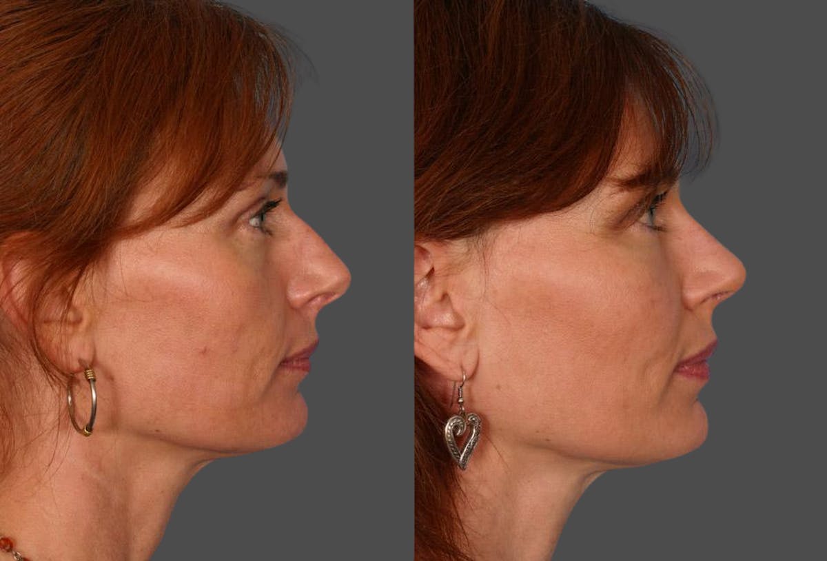 Facial Fat Transfer Before & After Gallery - Patient 704361 - Image 3