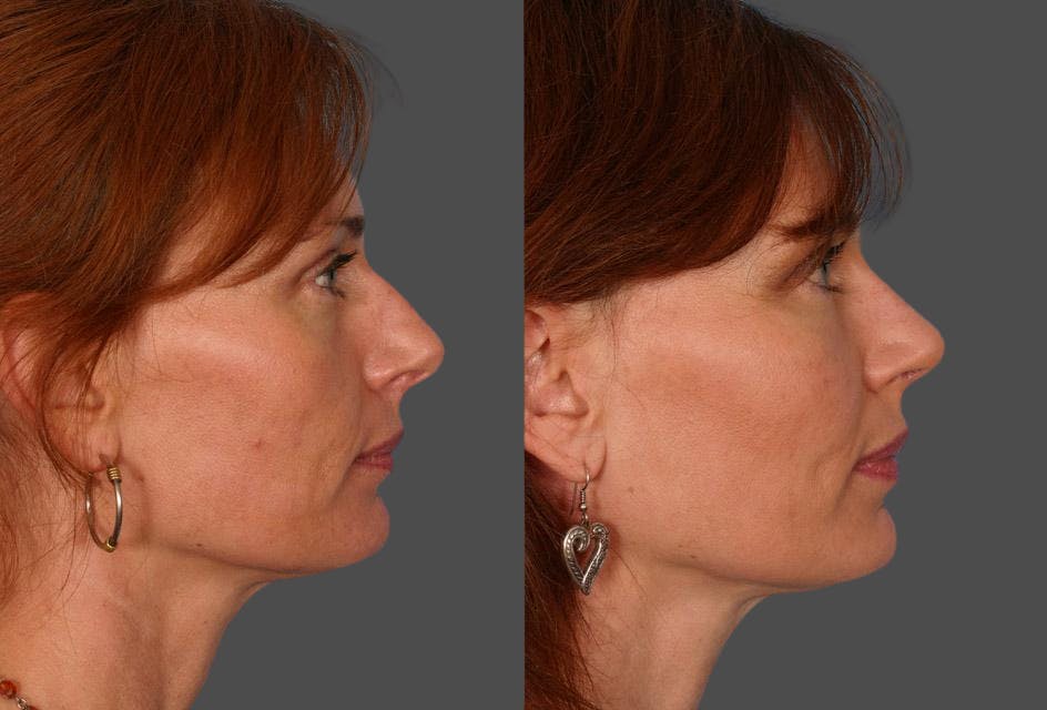 Facial Fat Transfer Before & After Gallery - Patient 704361 - Image 3