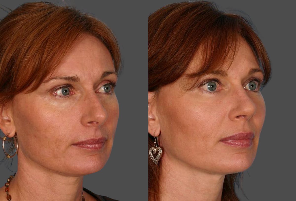 Facial Fat Transfer Before & After Gallery - Patient 704361 - Image 2