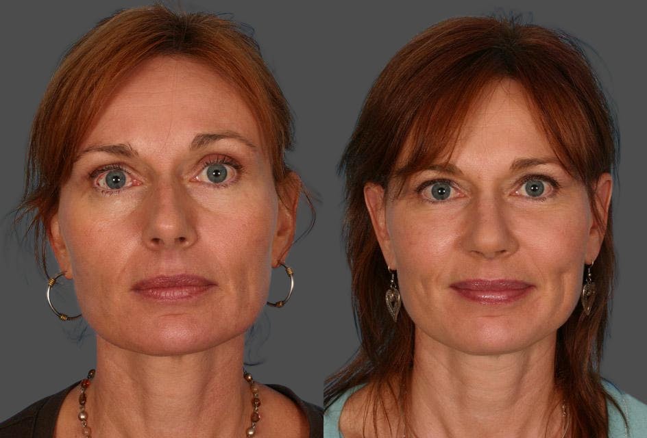 Facial Fat Transfer Before & After Gallery - Patient 704361 - Image 1