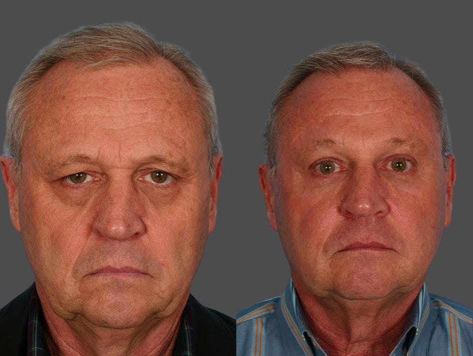 Facial Fat Transfer Before & After Gallery - Patient 344736 - Image 1