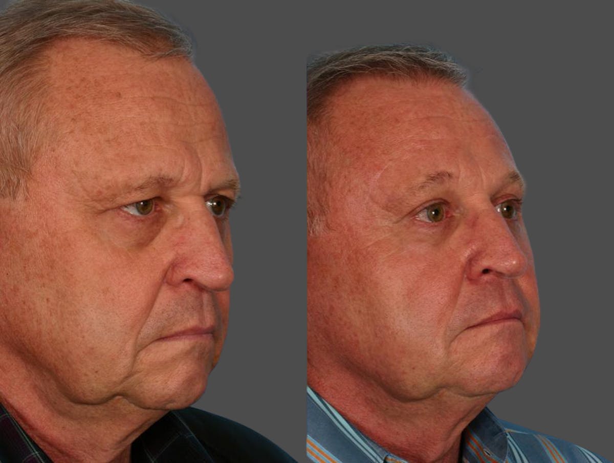 Facial Fat Transfer Before & After Gallery - Patient 344736 - Image 2