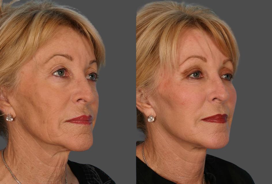 Limited Incision Facelift Before & After Gallery - Patient 113129 - Image 2