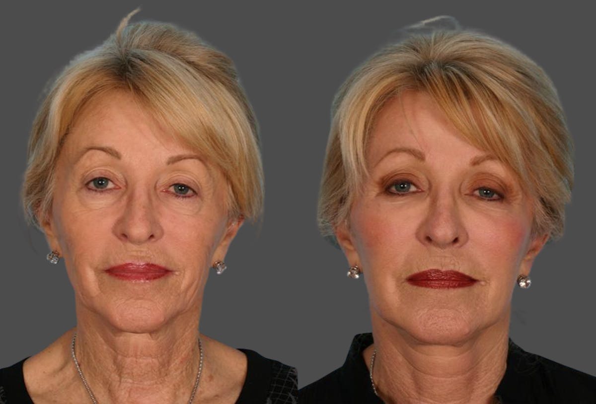 Limited Incision Facelift Before & After Gallery - Patient 113129 - Image 1
