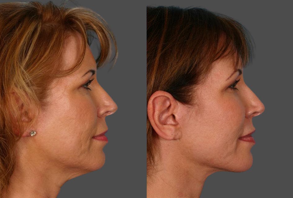 Facial Fat Transfer Before & After Gallery - Patient 354303 - Image 3