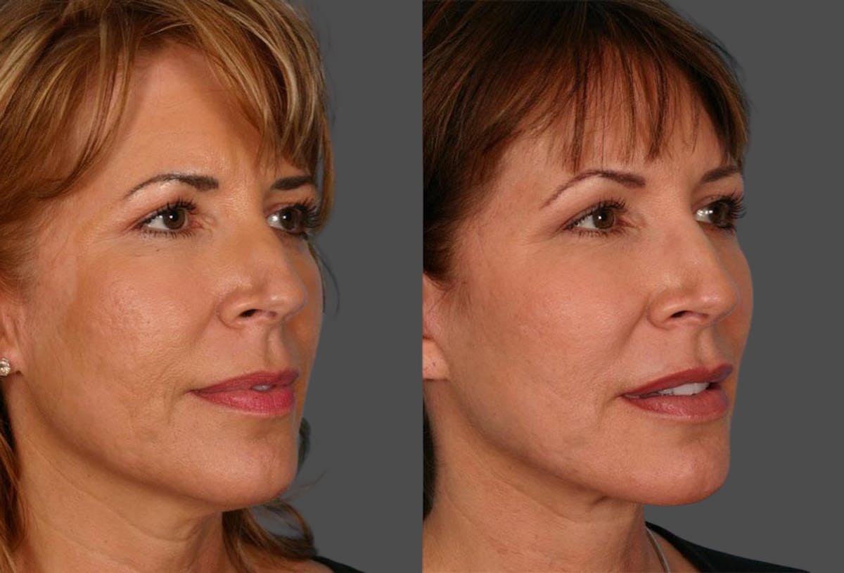 Facial Fat Transfer Before & After Gallery - Patient 354303 - Image 2