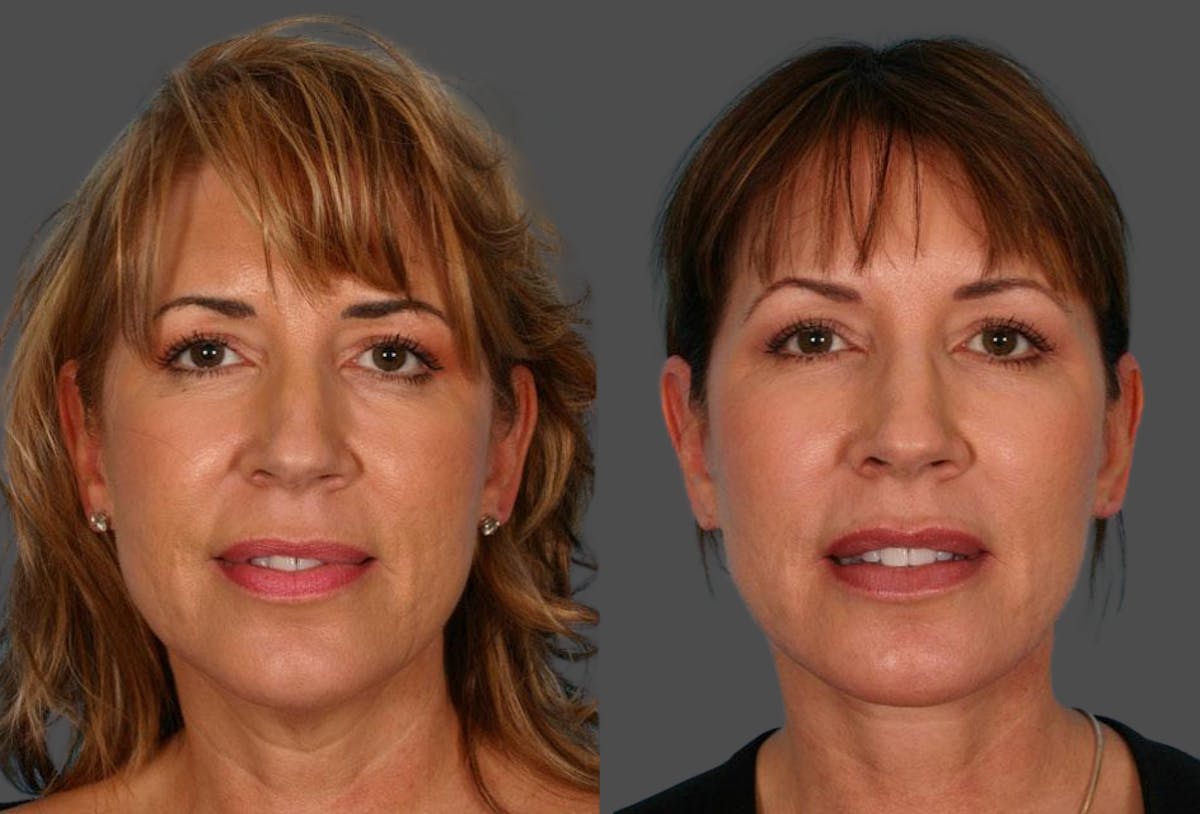 Facial Fat Transfer Before & After Gallery - Patient 354303 - Image 1