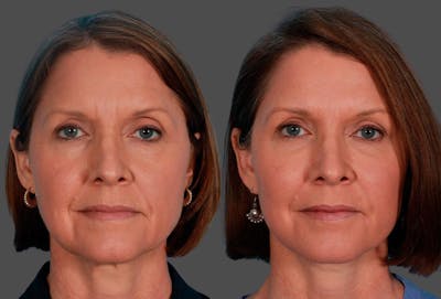 Limited Incision Facelift Before & After Gallery - Patient 368626 - Image 1