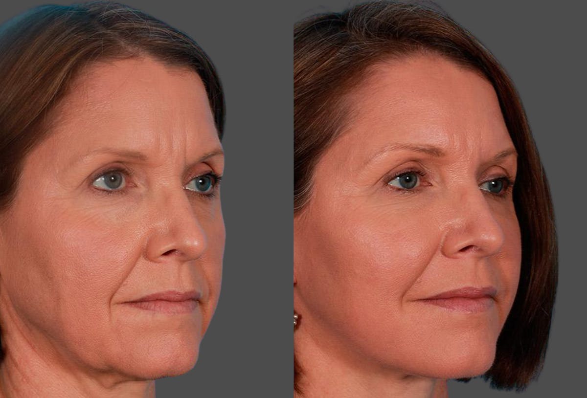 Limited Incision Facelift Before & After Gallery - Patient 368626 - Image 2