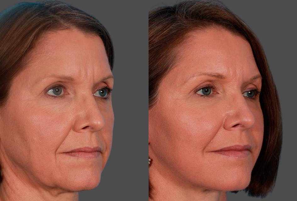 Limited Incision Facelift Before & After Gallery - Patient 368626 - Image 2