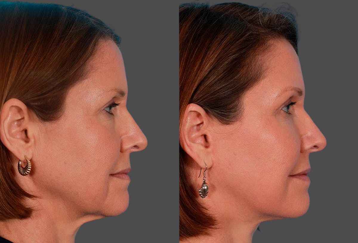 Limited Incision Facelift Before & After Gallery - Patient 368626 - Image 3
