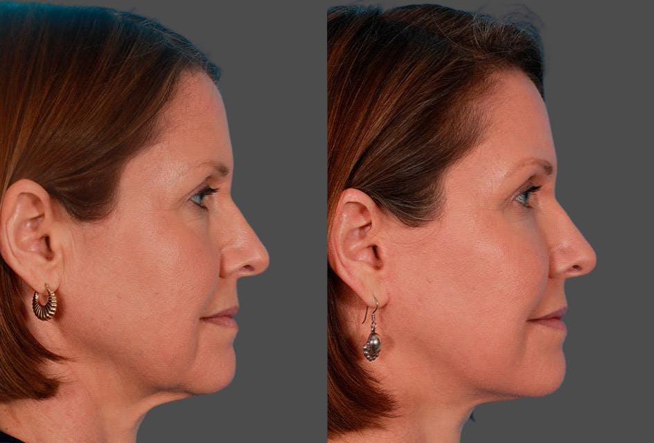 Limited Incision Facelift Before & After Gallery - Patient 368626 - Image 3