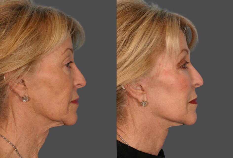 Limited Incision Facelift Before & After Gallery - Patient 113129 - Image 3