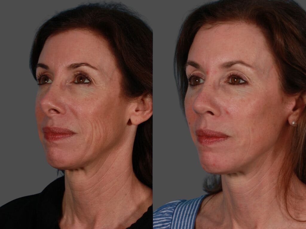 Limited Incision Facelift Before & After Gallery - Patient 421375 - Image 2