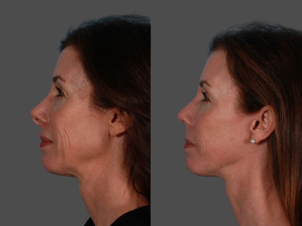 Limited Incision Facelift Before & After Gallery - Patient 421375 - Image 3