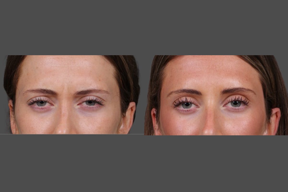 Sculptra Before & After Gallery - Patient 208313 - Image 7