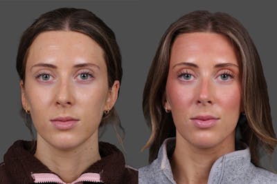 BOTOX® Before & After Gallery - Patient 268970 - Image 1