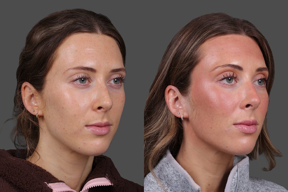 Sculptra Before & After Gallery - Patient 208313 - Image 2