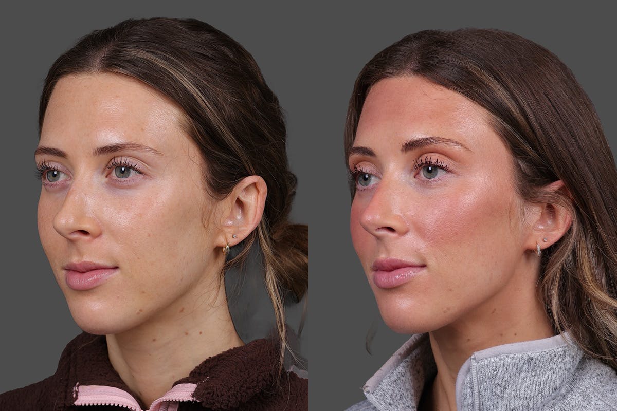Sculptra Before & After Gallery - Patient 208313 - Image 3