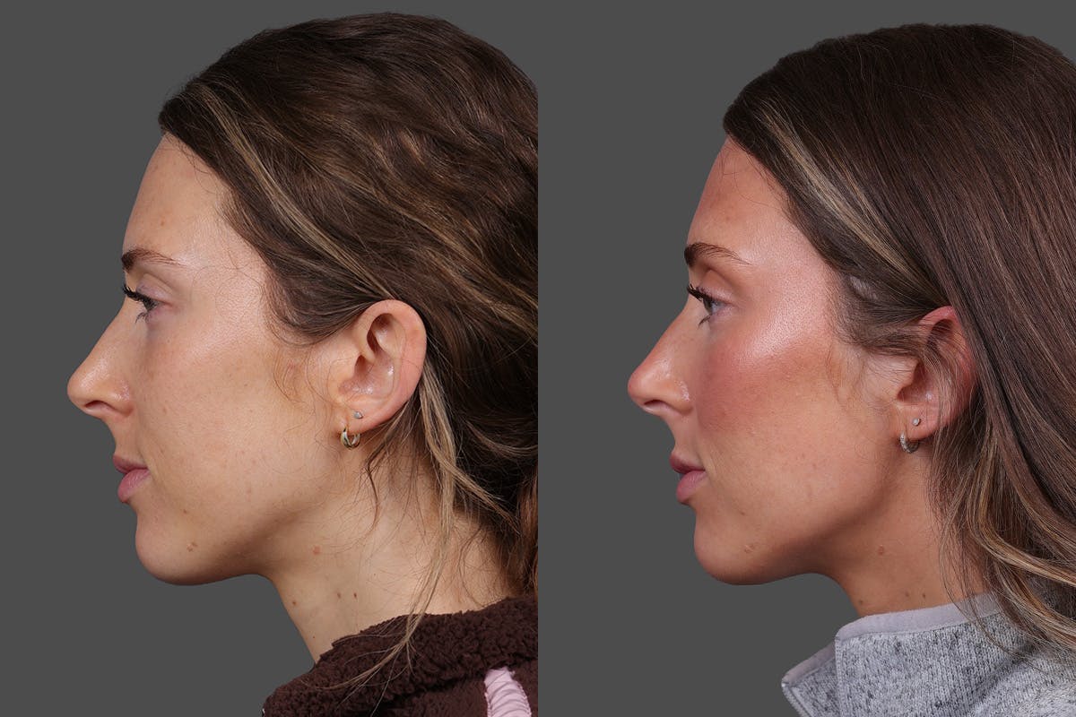 Sculptra Before & After Gallery - Patient 208313 - Image 4