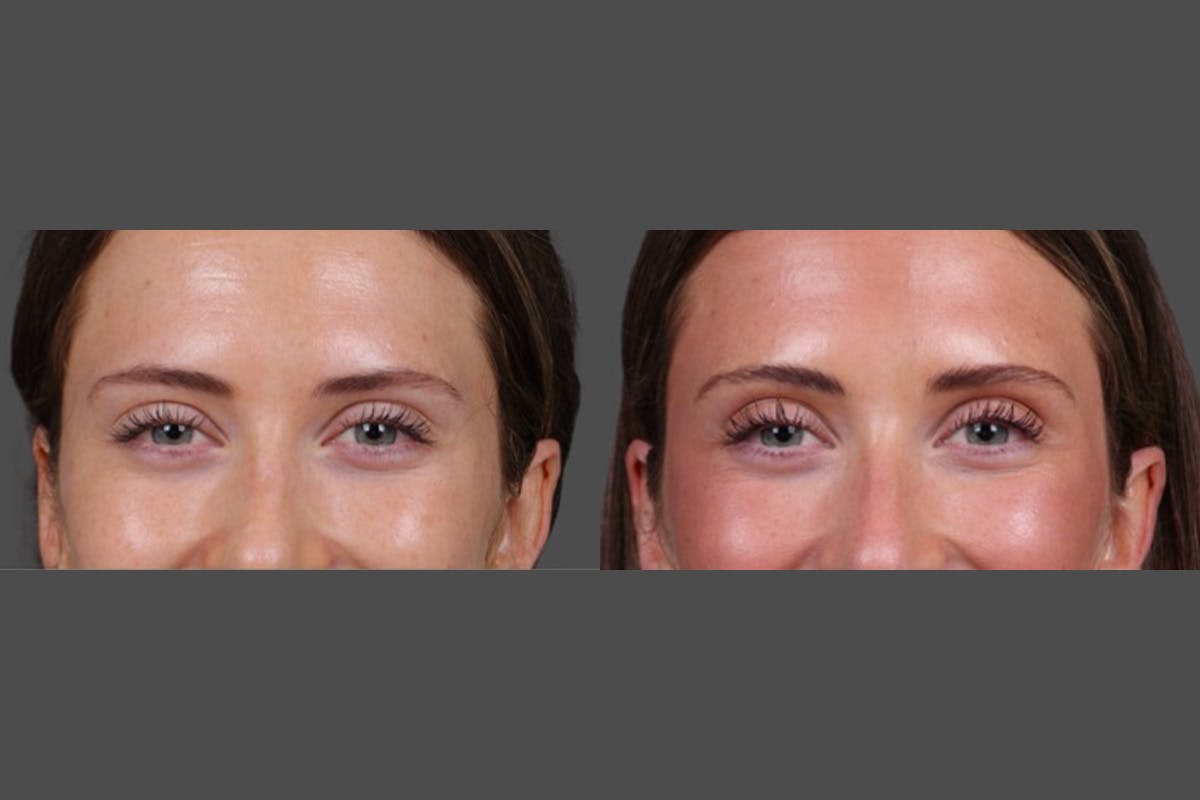 Sculptra Before & After Gallery - Patient 208313 - Image 6