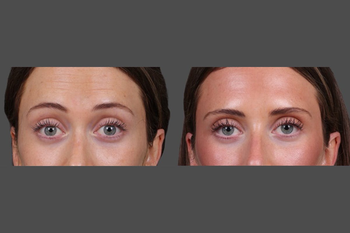 Sculptra Before & After Gallery - Patient 208313 - Image 5