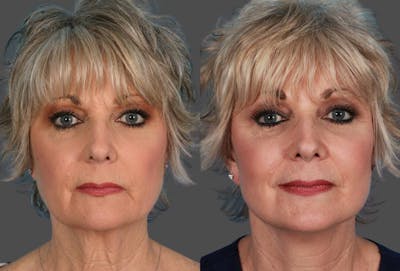 Limited Incision Facelift Before & After Gallery - Patient 851036 - Image 1