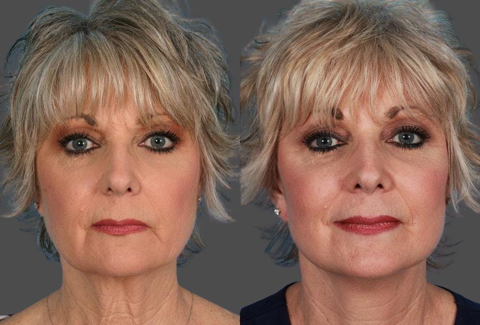 Limited Incision Facelift Before & After Gallery - Patient 851036 - Image 1