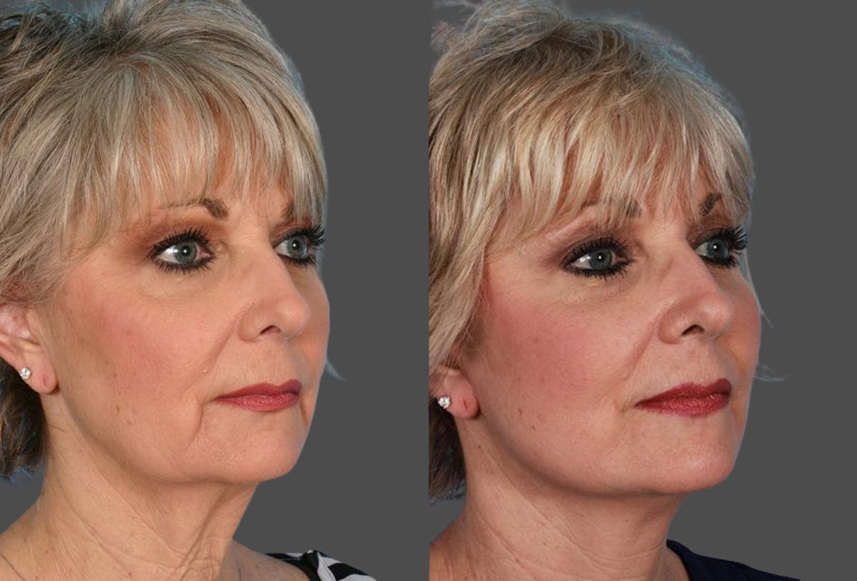 Limited Incision Facelift Before & After Gallery - Patient 851036 - Image 2