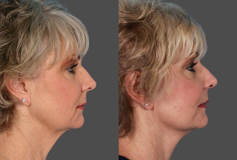 Limited Incision Facelift Before & After Gallery - Patient 851036 - Image 3