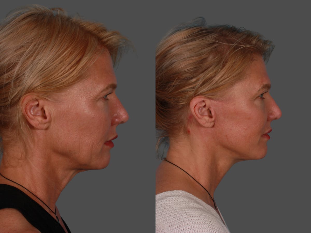 Limited Incision Facelift Before & After Gallery - Patient 342181 - Image 3