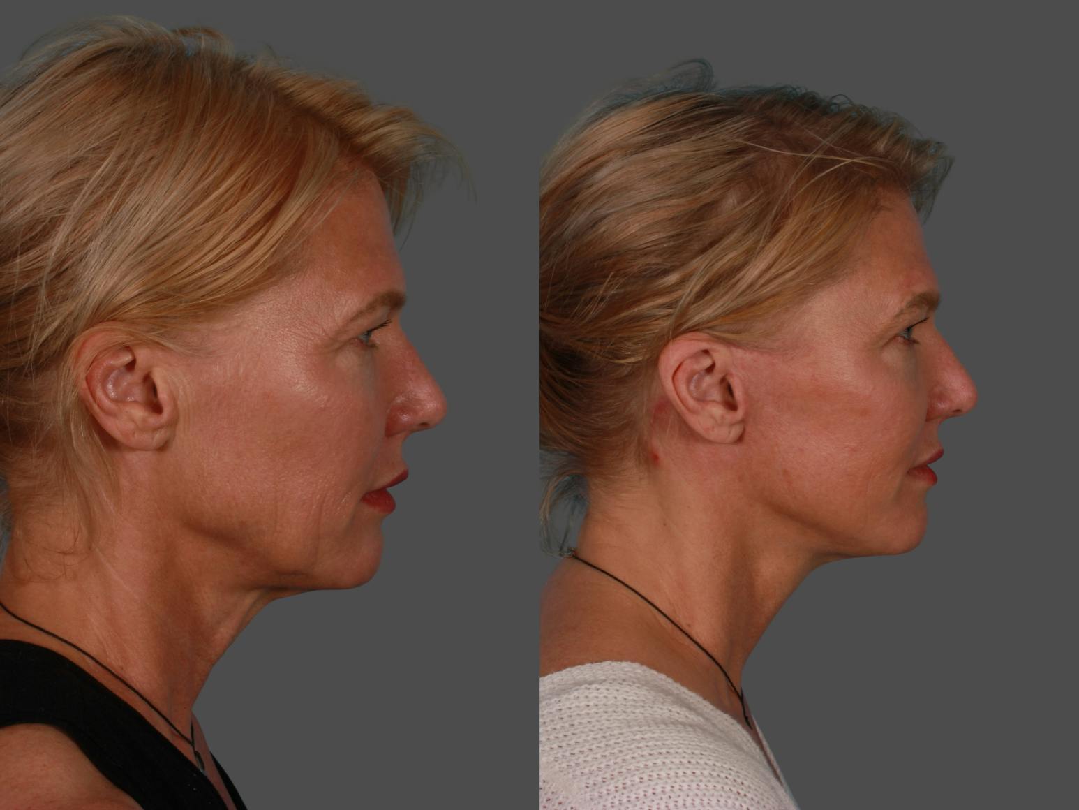 Limited Incision Facelift Before & After Gallery - Patient 342181 - Image 3