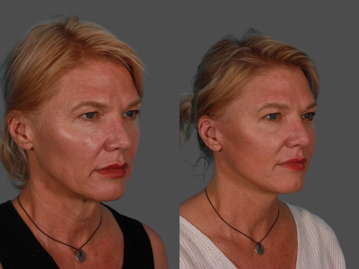 Limited Incision Facelift Before & After Gallery - Patient 342181 - Image 2