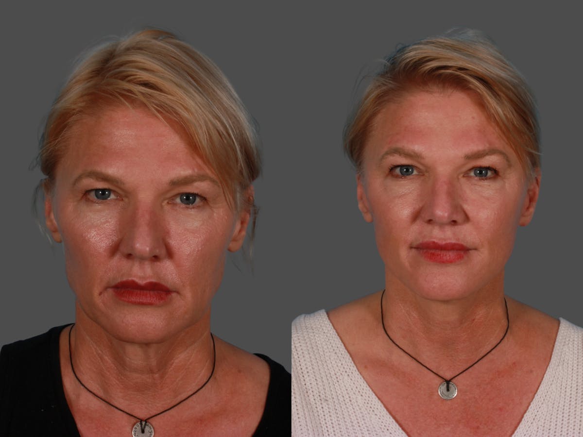Limited Incision Facelift Before & After Gallery - Patient 342181 - Image 1