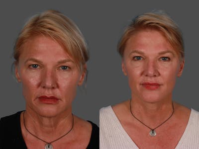 Limited Incision Facelift Before & After Gallery - Patient 342181 - Image 1