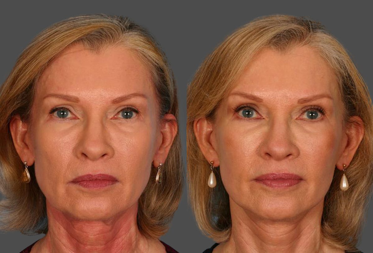 Limited Incision Facelift Before & After Gallery - Patient 276560 - Image 1