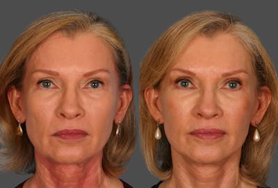 Limited Incision Facelift Before & After Gallery - Patient 276560 - Image 1