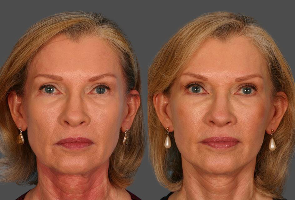 Limited Incision Facelift Before & After Gallery - Patient 276560 - Image 1