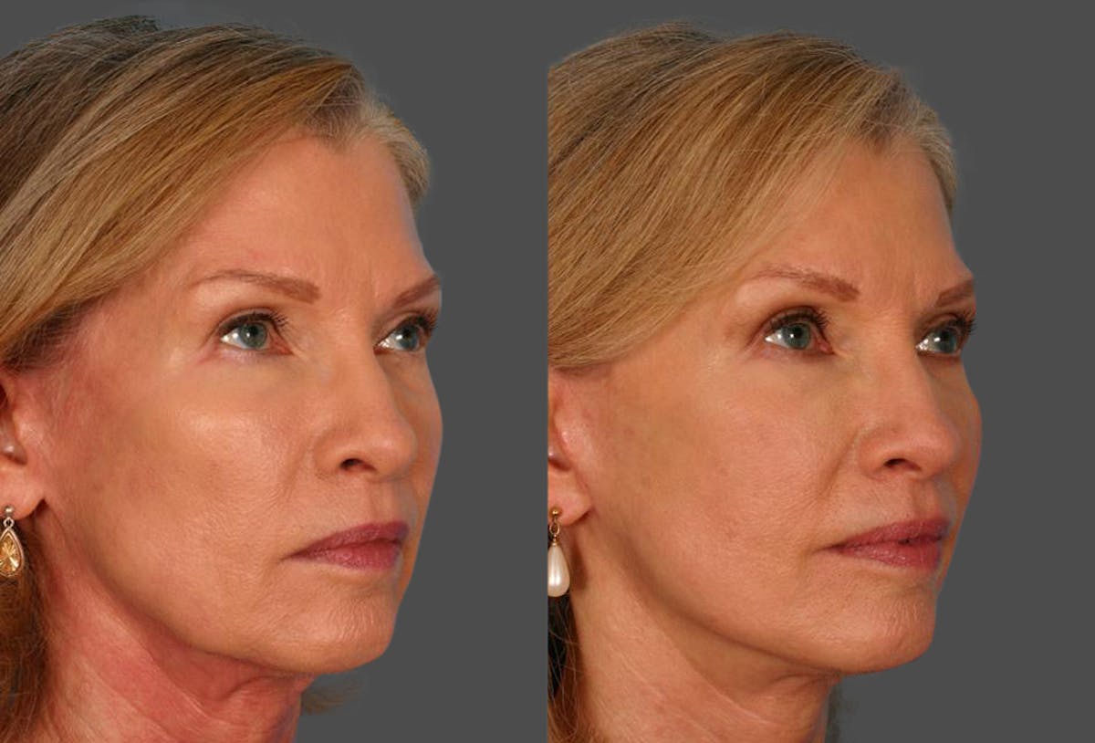Limited Incision Facelift Before & After Gallery - Patient 276560 - Image 2