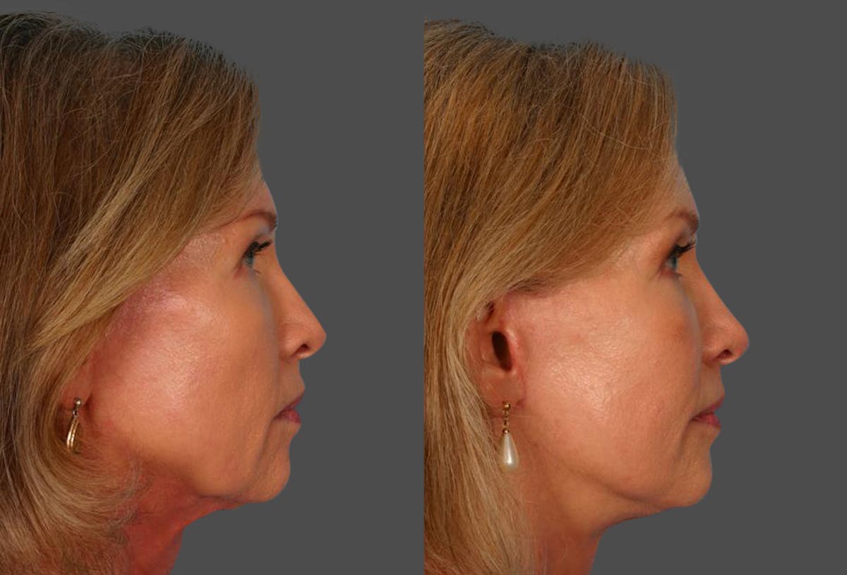 Limited Incision Facelift Before & After Gallery - Patient 276560 - Image 3