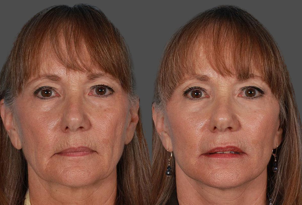 Limited Incision Facelift Before & After Gallery - Patient 227132 - Image 1
