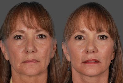 Limited Incision Facelift Before & After Gallery - Patient 227132 - Image 1